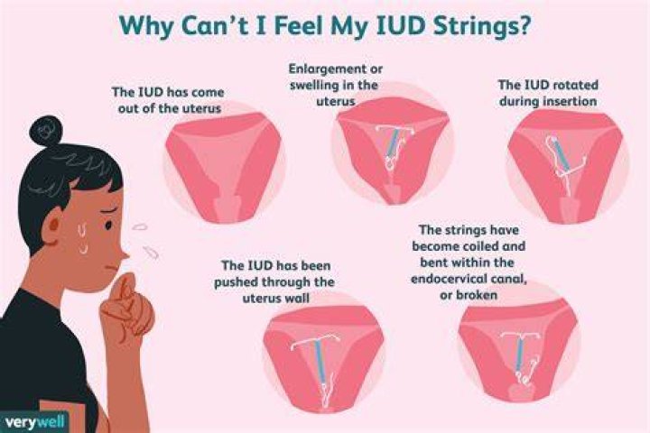 Can my IUD fall out without me knowing?