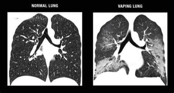 Does vaping damage your lungs?