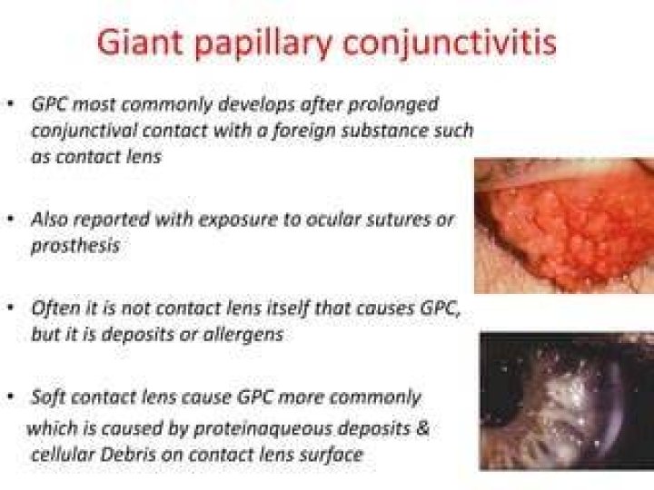 How is large papillary conjunctivitis treated?