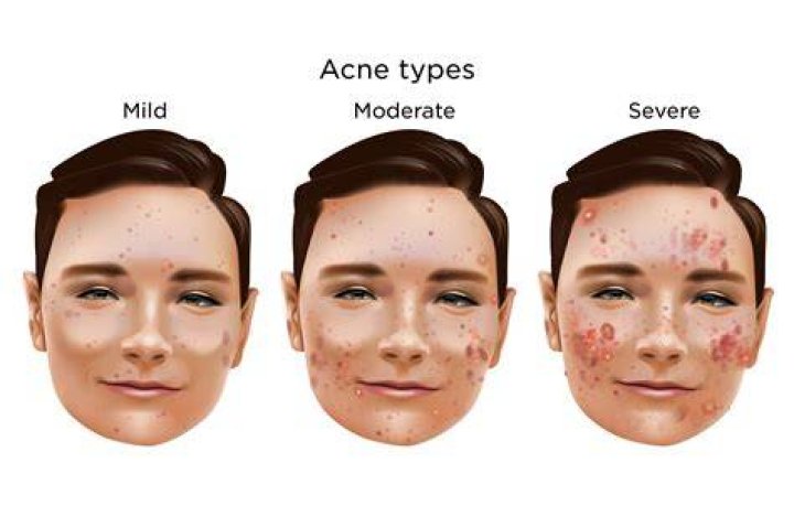 How long does it take to get rid of mild acne?