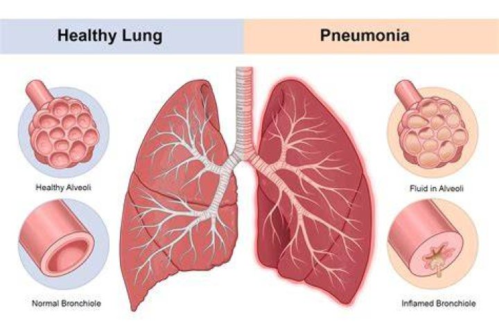 What is a rare form of pneumonia?