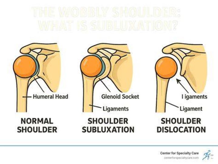 What is a subluxation diagnosis?